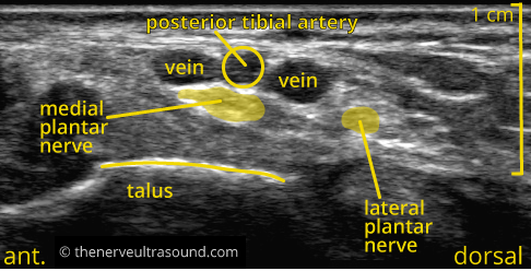 Standard sections tibial nerve – The Nerve Ultrasound