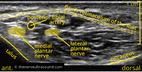 Standard sections tibial nerve – The Nerve Ultrasound